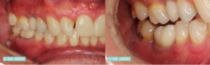 Before Dental Implants Right Side Patient 1a