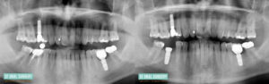 Dental Implants Full Mouth X-ray Before and After Patient 1.1b