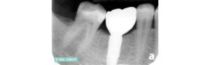 Dental Implants Close Up X-ray Before and After Patient 2.1c