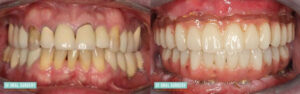 Dental Implants Before and After Patient 3.2a