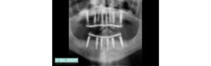 Dental Implants Full Mouth X-ray Patient 6.2d