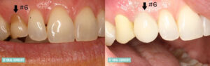 Dental Implants Before and After Tooth #6