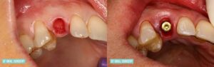 Dental Implants Before and After Patient 8.3b