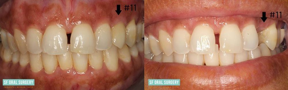 Dental Implants Before and After Tooth #11 View 2