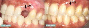 Dental Implants Before and After Tooth #11