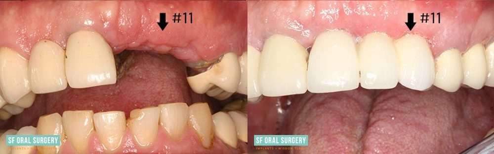Dental Implants Before and After Tooth #11 View 3