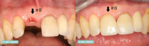 Dental Implants Before and After Tooth #8